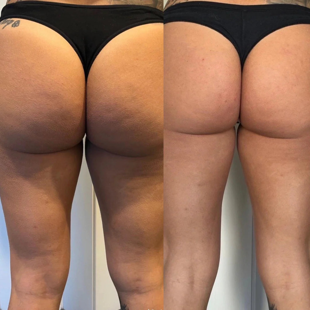 CelluSmooth™ - Anti cellulite massageapparat